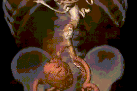 我院成功救治一例巨大动脉瘤破裂患者