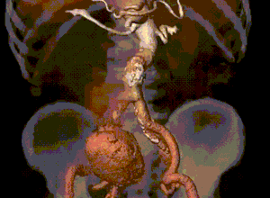 我院成功救治一例巨大动脉瘤破裂患者