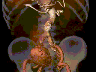 我院成功救治一例巨大动脉瘤破裂患者