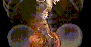 我院成功救治一例巨大动脉瘤破裂患者