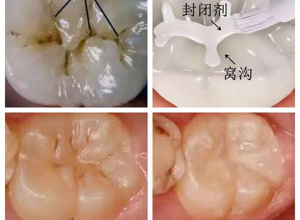 2024年度宁夏儿童口腔疾病综合干预项目启动