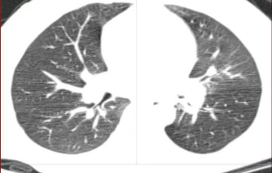 儿科支气管镜下支气管异物取出术